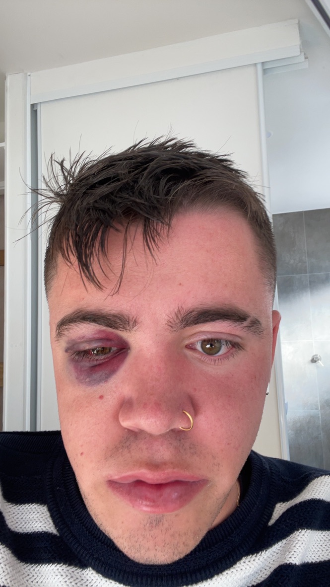 Tom’s actual black-eye photo.